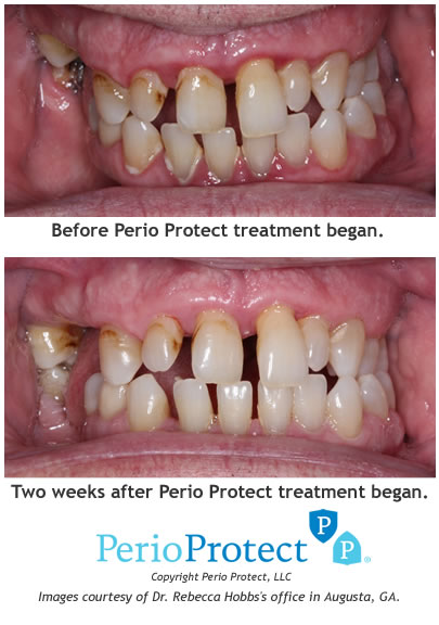 Perio Protect treatment example, before and after